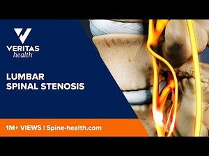 Lumbar Spinal Stenosis