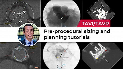 Structural Heart Disease pre-procedural sizing and planning tutorials: : TAVR / TAVI