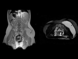 Difference Between Hyperventilation and Tachypnea
