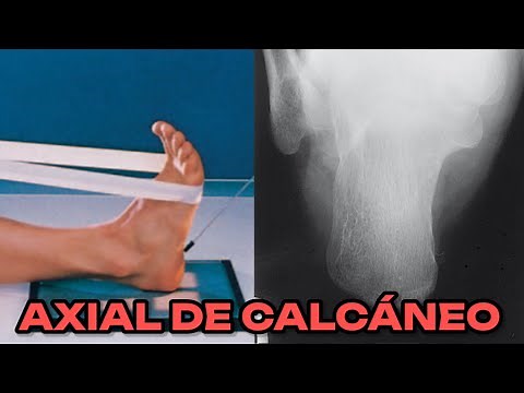 AXIAL PLANTODORSAL CALCANEAL X-RAY (POCKET MANUAL) #31