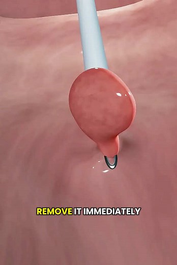 Colonoscopy Procedure Explained with 3D Animation