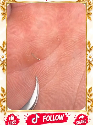 Deep Blackhead Extraction & Satisfying Popping | Wait for the most satisfying pop 😳🫣 You won’t believe what comes out! #pimplepoppersatisfying #Acne #pimple #Blackhead #Satisfying