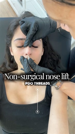 PDO Nose Thread Lift is the perfect way to refine the tip, lift the bridge, and create definition ✅