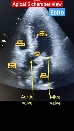 Apical 5 chamber view Echo l Aortic valve in echo #echo #shorts