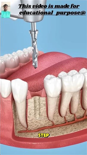 Tooth Extraction and Dental Implant Process Explained | Step-by-Step Dental Treatment