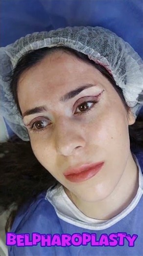👉 😱 Upper Blepharoplasty Before & After | Wait Until You See the Result!