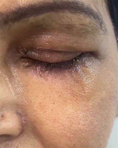 Before and After lower eyelid lag correction