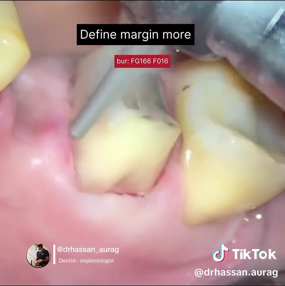 Complete Guide to Crown Preparation Techniques in Dentistry
