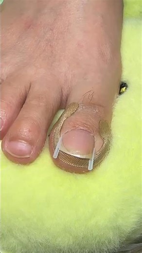 Brand:Zytiqt100 PCS Ingrown Toe Nail Remover,Toe Nail Corrector and Ingrown Toenail Correction Tool,