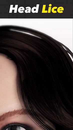 Head Lice In Scalp 3D Animation #headlice #lice #liceremoval #headliceremoval #headliceinfestation #medical3danimation #3dmedicalanimation