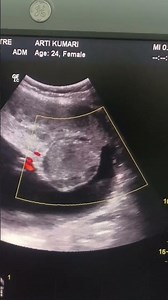 placental Chorangioma Lesion | Grading | Obstetric Ultrasound Doppler | fetus Anomaly | Radiologist
