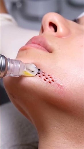 Professional Jawline Blackhead Removal | ASMR #viral #foryou #viralvideo #viralshorts #fyp #virals