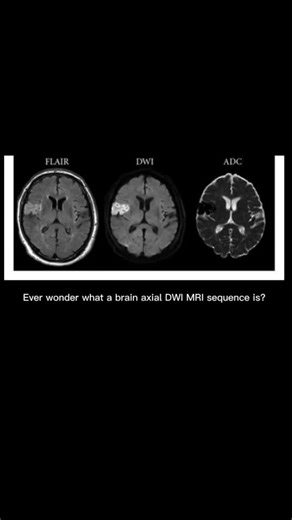 MRI Man on Instagram: "A powerful MRI sequence to detect brain strokes. AX Dwi and ADC #mri #radiology #xray #radiologist #medicine #ctscan #radiologia #medical #radtech #ct #imaging #radiographer #xraytech #medicalimaging #radiologytech #ultrasound #xrays #healthcare #doctor #radiologylife #radiologystudent #hospital #radiography #nurse #xraystudent #medicalstudent #health #medstudent #mritech"