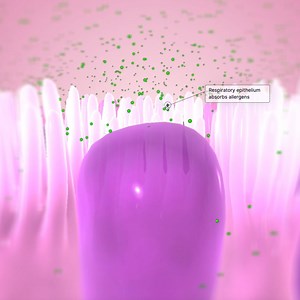 Asthma is a chronic inflammatory disease of the respiratory system that is characterized by hypersensitive and hyperreactive airways. When triggered, the airways will experience episodes of reversible airflow obstruction (asthma attacks). Here is a look at an asthma attack with the BioDigital Human. Learn more about BioDigital’s capabilities, features, and benefits: https://bit.ly/3vMy5tR | BioDigital | Facebook