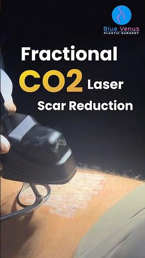 Fractional CO2 Laser for Scars: How It Reduces Acne, Surgical & Burn Scars