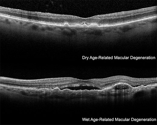 Macular Hole Surgery - Vitreous Retina Macula Consultants of New York