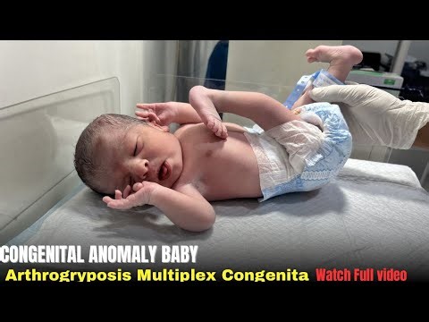 Baby Born with Congenital Anomaly (AMC) | Early Medical Care in NICU