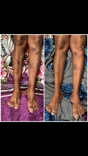 Enlever les cicatrices et taches noires sur les jambes