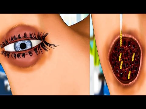 [ASMR ANIMATION] Removing Large eye armpit