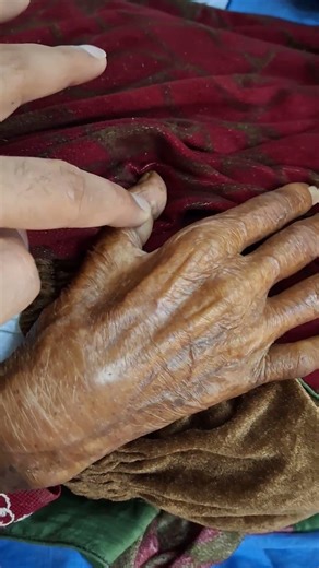 Guttering of interossei #clinicalexamination