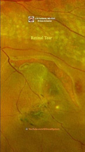 Retinal Tear. Retinal detachment. Laser photocoagulation.