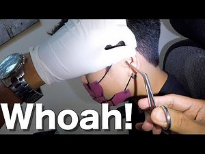 Stuck Insect Removed from Woman's Ear | What is it?