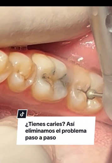 Eliminación de caries: Proceso paso a paso