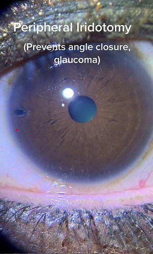 Understanding Peripheral Iridotomy for Glaucoma Treatment