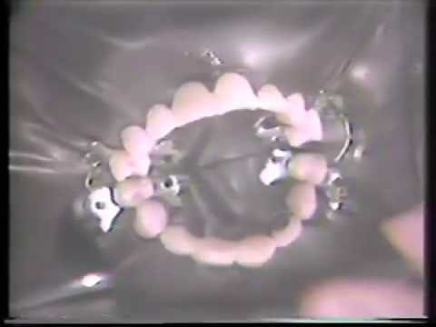 The Acid Etch Bridge