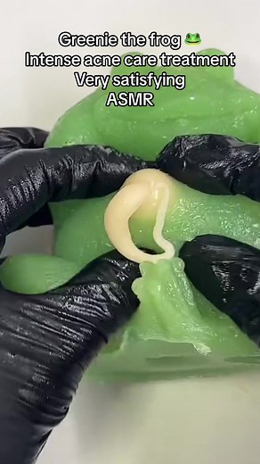 Plimple popping removal with healing music relaxing #viral #fypシ゚viral🖤tiktok #oddlysatisfying #us #asmr #fyp #pimplepopping #squishy #frogtiktok