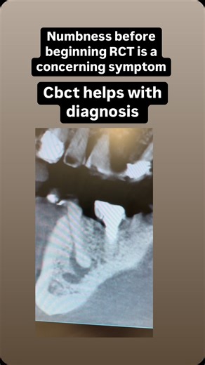 Cbct 3D Endo Apical periodontitis involving mental foramen #Diagnosis #Savingteeth | Specialist Endo Sydney- Clinical hacks
