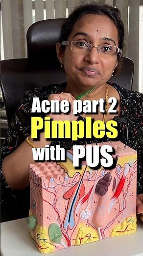 How To Treat Pus Filled Acne At Home | Papules & Pustules #trending