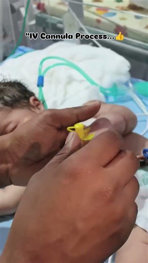 IV cannula process in children #viral #nicu