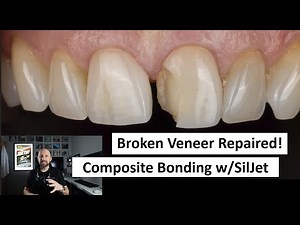 Broken Veneer Repair with Composite Bonding