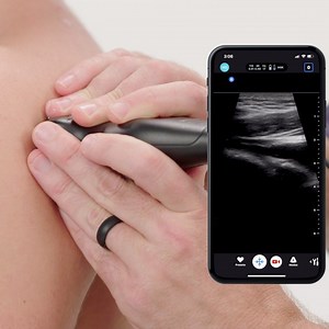 2.3K views · 76 reactions | Ultrasound evaluation of the glenohumeral joint allows you to assess for dislocation, reduction, and to guide joint aspiration or intra-articular injections. Dr. Mike Stone walks you through the nuts and bolts of this approach. Learn more from but experts on our education platform: www.butterflynetwork.com/education | Butterfly Network, Inc | Facebook