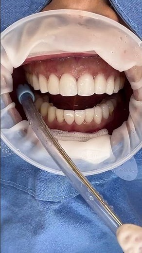 Lens-like Veneers in One Day #Veneers #NoAnesthesia #PainFree #OneDayDental #DrLeeHanNa #smile #v...