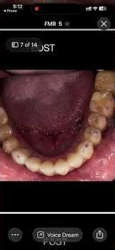 Bite analysis and FMR video