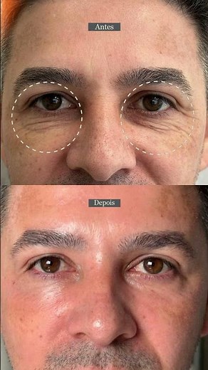 ✨ Rejuvenescimento da área dos olhos com o Laser CO2 Fracionado ✨