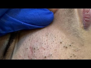 The Ultimate Facial Care Routine: Proven Remedies For Acne-Free Skin