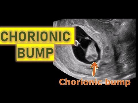CHORIONIC BUMP IN AN 8 WEEKS GESTATION