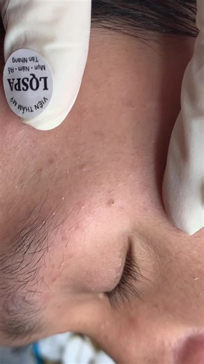 Chăm sóc da mụn hiệu quả tại Tân Bình