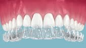 Invisalign braces or invisible retainer installation on teeth. Dental...