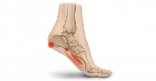 Everything You Need to Know About the Plantar Fascia Ligament