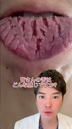 溝状舌について説明します😊☝️#歯医者 #おすすめ #舌 #口臭