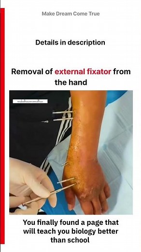 🔩 Removal of external fixator 🤜 from the hand 🩺 | MDCT