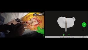 Ligament-Driven TKA Surgery: Tibia-First Workflow