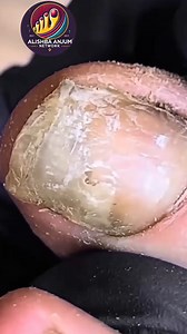 127K views · 400 reactions | Best Nail Practices for Elderly Toenails That Reduce Pain Naturally  #FootWellnessUSA #ThickToenailCare #SafeNailCare | Alishba Anjum vlog | Facebook