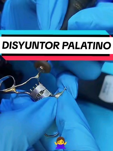 Pulir Perno Colado en Boca: Paso a Paso | Dental