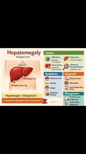 Hepatomegaly – Enlarged Liver Explained Simply 🩺 #short #short reels #viral