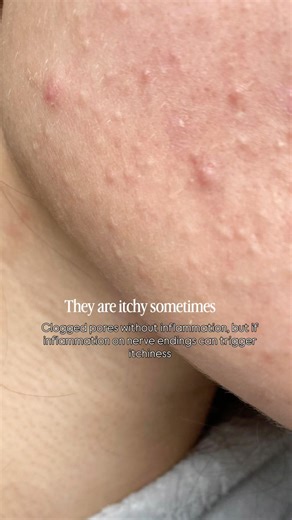 Comedonal acne is no joke treat it right !!! #ytshorts #shorts #yoitubeshorts